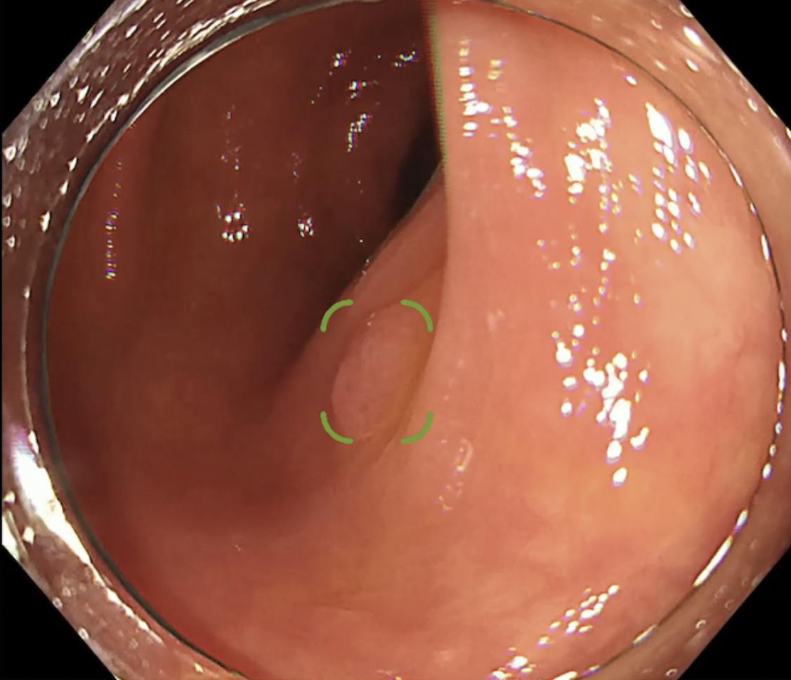 病変検出用内視鏡画像診断支援プログラム