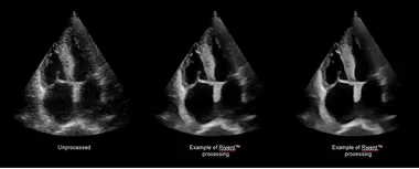 超音波装置・小型超音波装置組込用 2D画質改善ソフトウェアモジュール