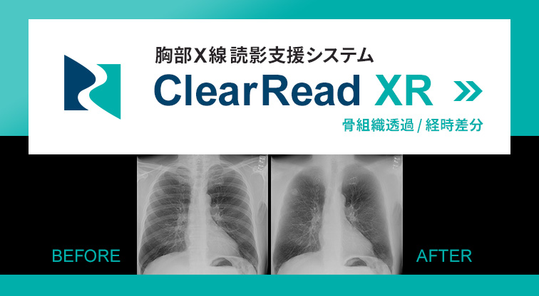 胸部X線読影支援システム　胸部X線骨組織透過／経時差分処理