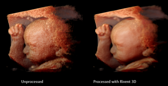 超音波装置組込用 3D画質改善ソフトウェアモジュール